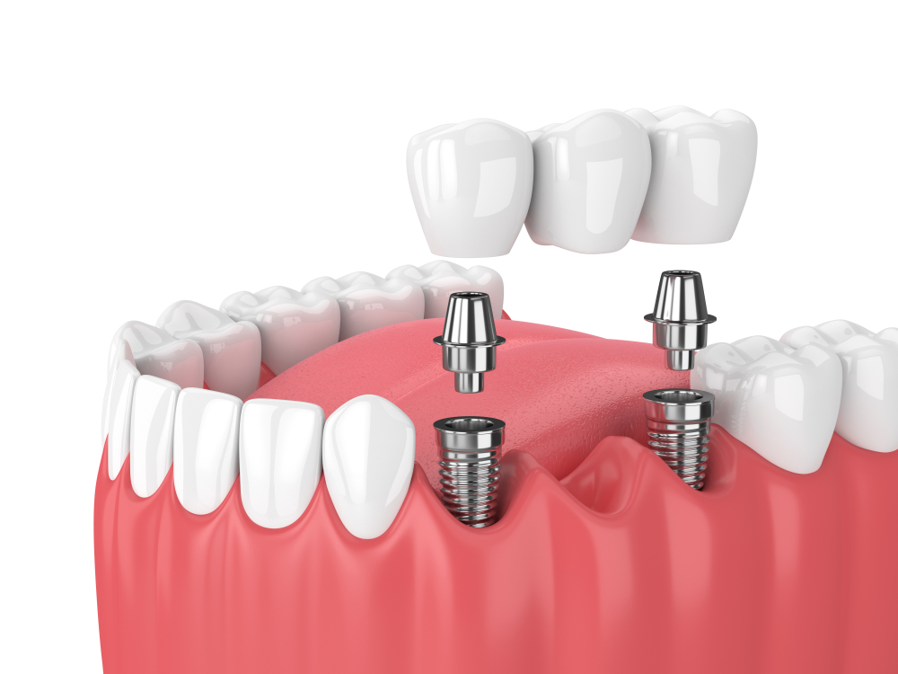 Implantes dentales Talagante