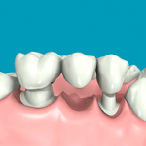 Prótesis dental fija