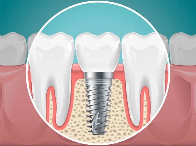 Implantes dentales Vitacura